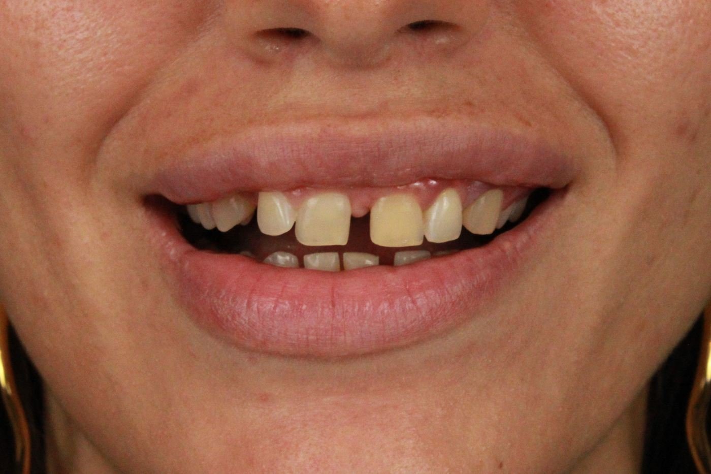 Lentes de resina antes e depois. Antes: espaço entre os dentes da frente e dentes amarelados