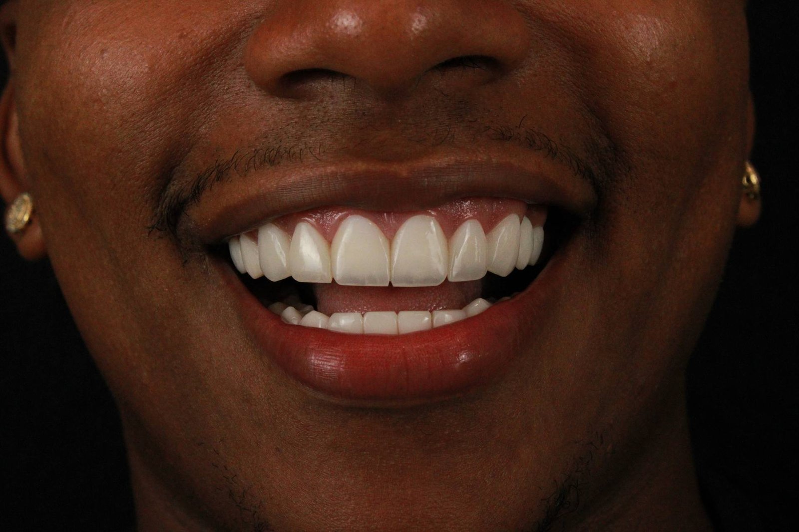 Close de sorriso com lentes de resina