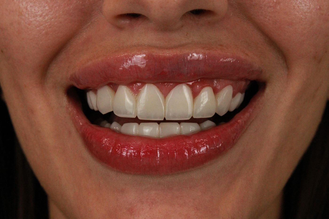 Lentes de resina antes e depois. Depois: espaço fechado e dentes claros e uniformes com lentes de resina