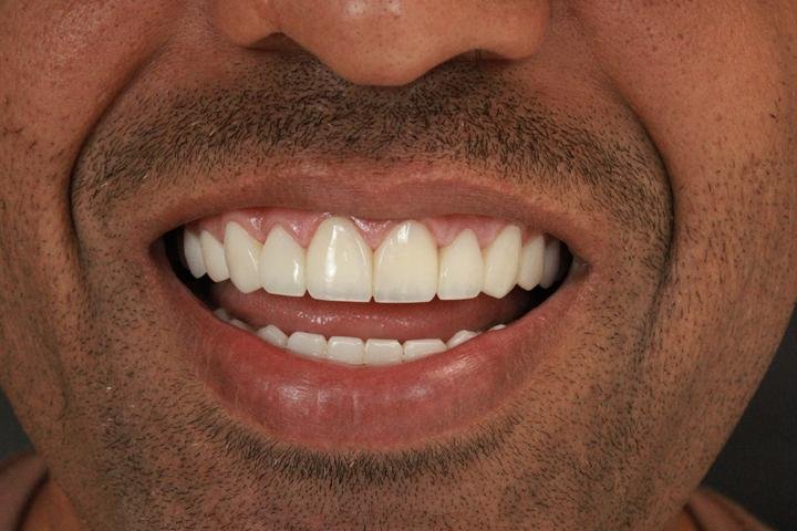 Sorriso com lentes de resina, caso 1