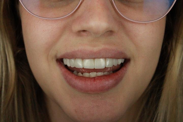Sorriso com lentes de resina, caso 2