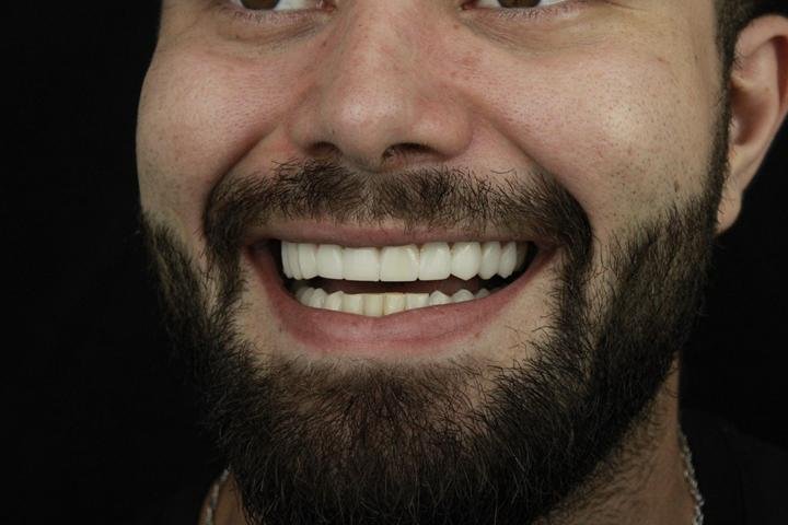 Close do sorriso de paciente com lentes de resina