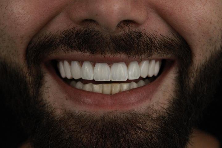 Sorriso com lentes de resina, caso 4