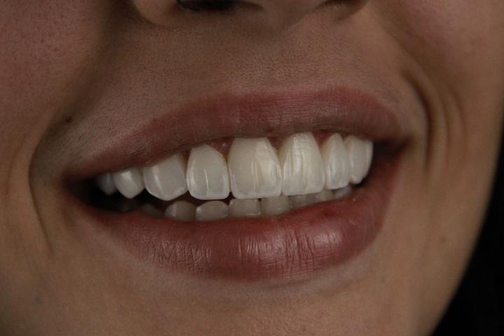 Sorriso com lentes de resina, caso 5