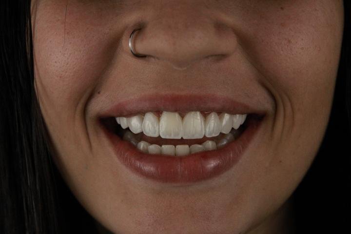 Sorriso com lentes de resina, caso 6