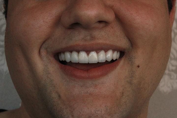 Sorriso com lentes de resina, caso 8