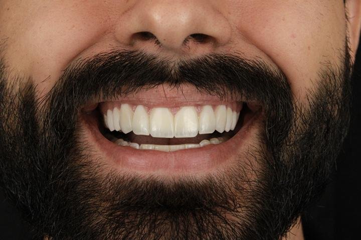 Sorriso com lentes de resina, caso 9