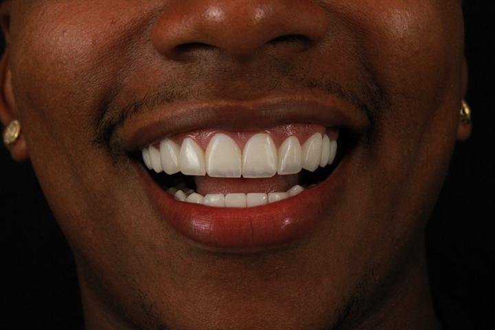 Close do sorriso de paciente com lentes de resina