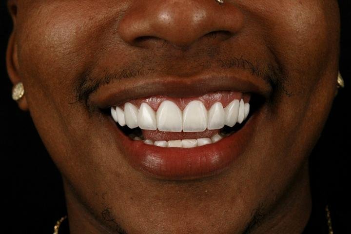Sorriso com lentes de resina, caso 11