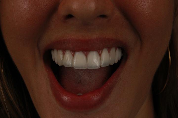 Sorriso com lentes de resina, caso 12