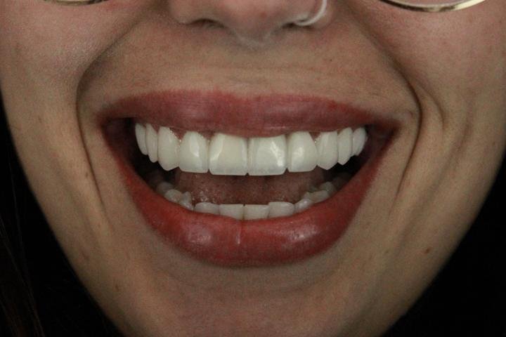 Sorriso com lentes de resina, caso 13