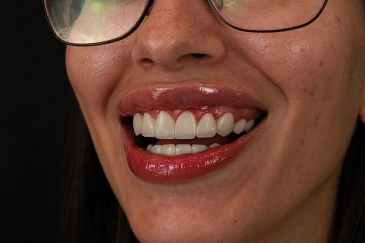 Sorriso com lentes de resina, caso 14