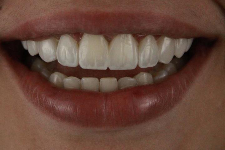 Sorriso com lentes de resina, caso 15