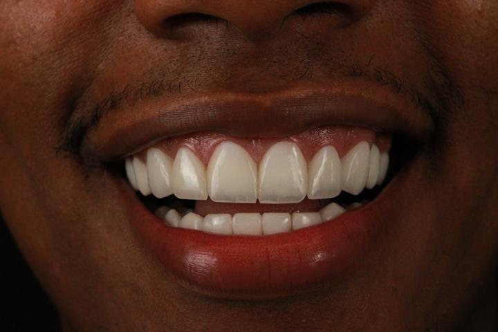 Sorriso com lentes de resina, caso 16