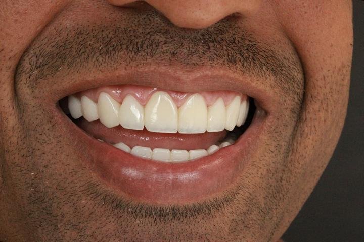 Sorriso com lentes de resina, caso 17