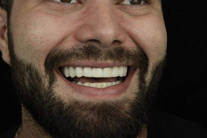 Sorriso com lentes de resina, caso 18